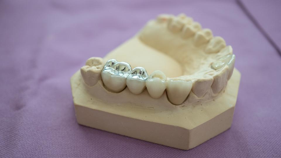 model of teeth with amalgam fillings in